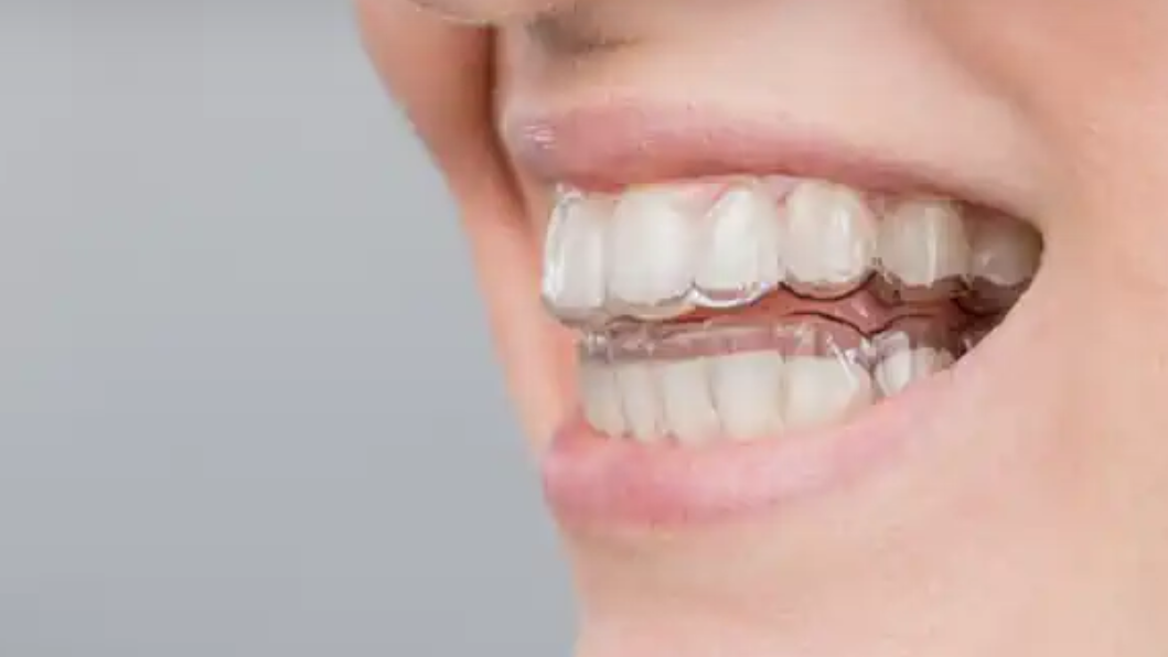 What Should You Do When Your Invisalign Is Not Tracking